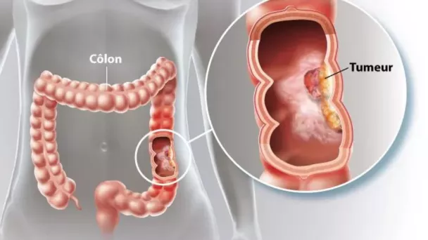 le cancer du côlon, symptômes et diagnostic